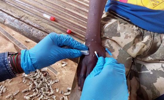 Mpox : l’OMS préconise un accès rapide aux tests et invite les fabricants à procéder à un examen d’urgence